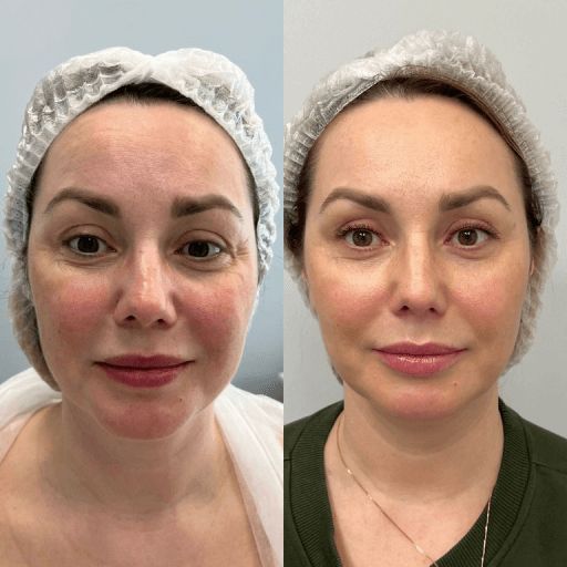 Before & After